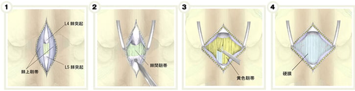 顕微鏡下腰椎手術(2)
