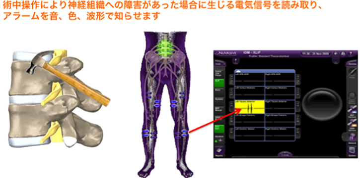 当院で使用している術中神経モニタリングシステム