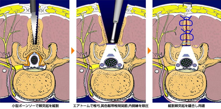 顕微鏡下腰椎手術(1)
