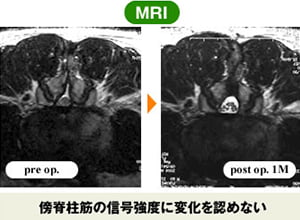 顕微鏡下腰椎手術(2)