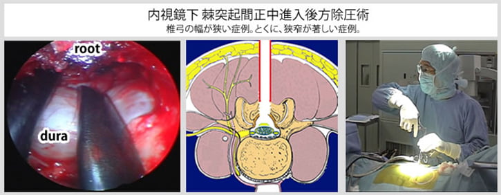 腰椎内視鏡下手術