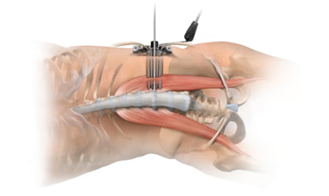 低侵襲脊椎固定術(XLIF)について
